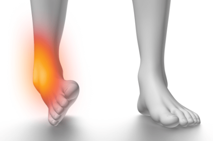 捻挫改善プログラム